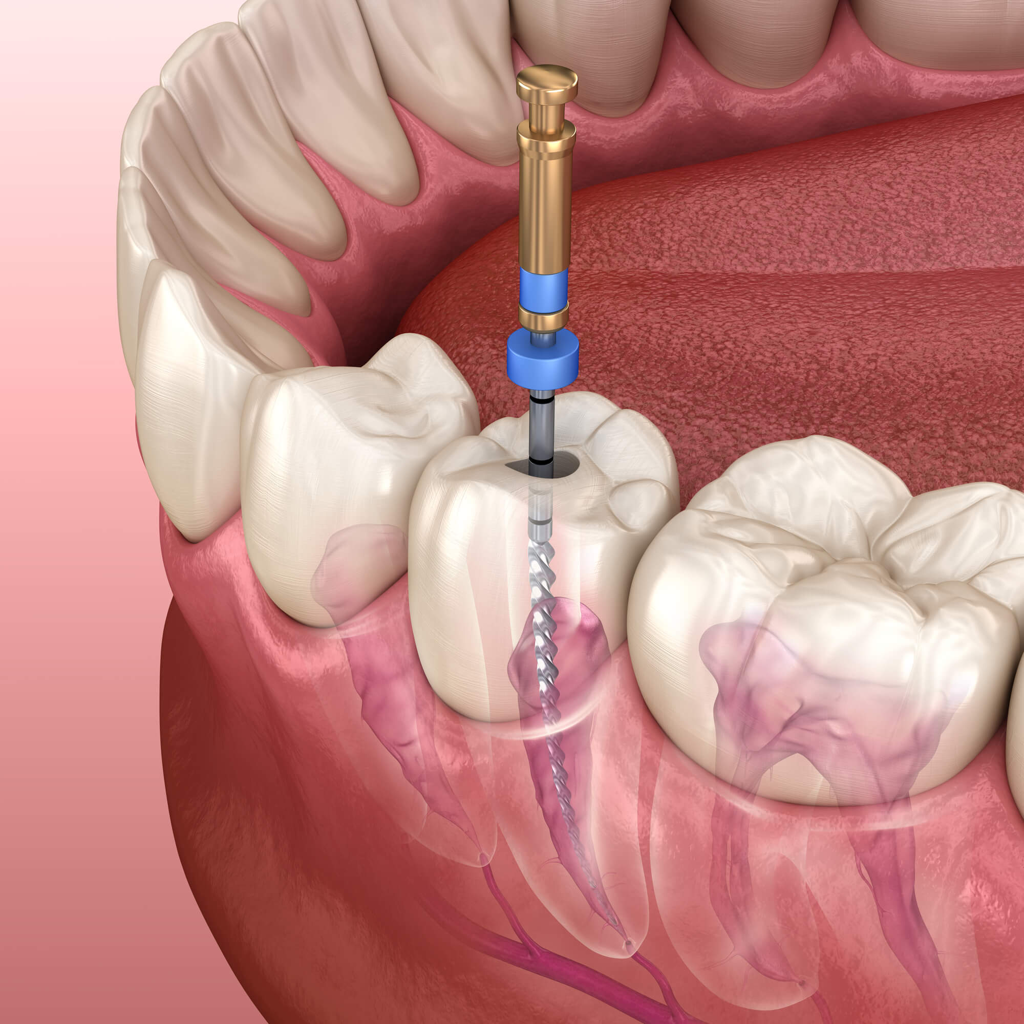 Endodontic root canal treatment process. Medically accurate tooth 3D illustration in Lisle, IL
